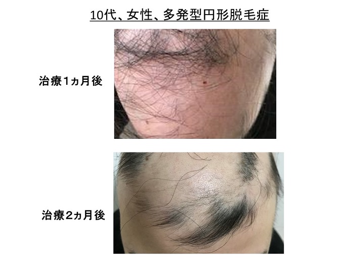 円形脱毛症　病院
